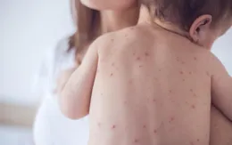 Khuyến cáo đối với hành khách quốc tế liên quan đến bệnh sởi