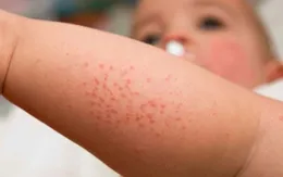 Mỹ ghi nhận hơn 1.000 ca nhiễm sởi