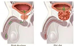 Tiền liệt tuyến và những công dụng tuyệt vời của Đông trùng hạ thảo