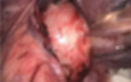Phẫu thuật lấy khối u trung thất nằm ở vị trí "hiểm"
