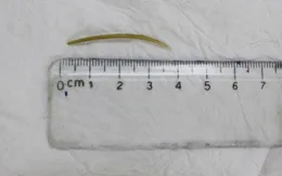 Nuốt xương cá dài 4cm khi ăn lẩu gây thủng ruột non