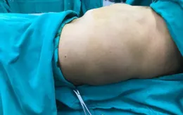 Chủ quan, người đàn ông sống với khối u huyết quản khổng lồ 10 năm