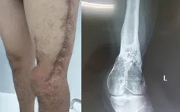 Lần đầu ghép gân cơ tứ đầu đùi hồi phục chân trái bị thương do tai nạn giao thông