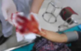 Nam thanh niên bị máy làm mộc nghiền nát bàn tay phải