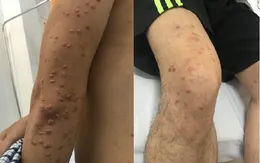 Người đàn ông trẻ vào viện với làn da nổi đầy u cục