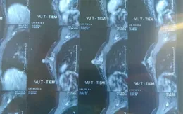 Cảnh báo tình trạng trẻ hóa ung thư vú