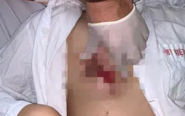 "Nâng cấp" ngực sau sinh con, một phụ nữ ở Hà Nội bị biến chứng nhập viện