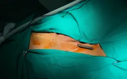 Nhảy trên xe xuống, người đàn ông bị thanh sắt xuyên thấu đùi bụng
