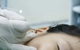 Xem bác sĩ gắp hạt cườm trong tai gây mủ, khiến bé gái 8 tuổi đau nhức