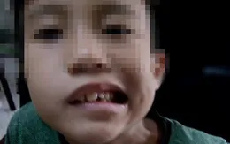Ngủ dậy, bé trai bỗng dưng bị méo miệng, liệt mặt