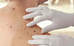 Tỷ lệ ung thư da ở Anh tăng 45%