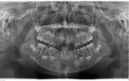 Cảnh giác rối loạn mọc răng vĩnh viễn ở trẻ em