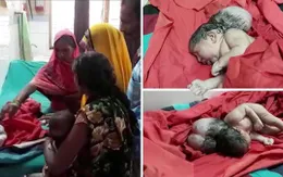 Bé gái sơ sinh... “ba đầu” tại Ấn Độ