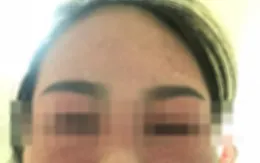 Tin vào công dụng làm đẹp của mỹ phẩm, cô gái trẻ bị nhiễm trùng toàn thân