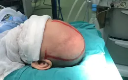 Mắc dị tật hộp sọ bẩm sinh, bé 5 tháng tuổi không thể ngóc nổi đầu