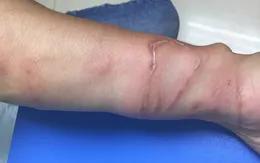 Cẩn thận bỏng sứa khi đi tắm biển ngày hè