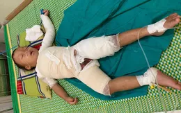 Bé trai hơn 3 tuổi người Mông bị bỏng nước sôi nguy kịch cần giúp đỡ