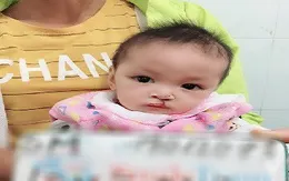 Ghép xương hàm, xương ổ răng điều trị dị tật bẩm sinh khe hở môi, vòm miệng