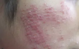 Tai biến do lăn kim, tiêm vi điểm
