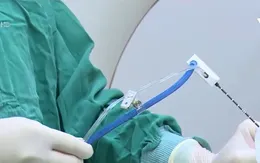 Bệnh viện đầu tiên ở Đông Nam Á đốt u bằng vi sóng