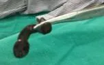Đi chăn trâu uống nước suối, bé trai người Mông bị đỉa dài 6cm sống trong khí quản