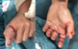 Nối ngón tay bị đứt lìa do cưa máy cắt cho thanh niên 18 tuổi