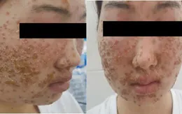 Khuôn mặt phủ kín vảy sau khi dùng sữa rửa mặt mua qua mạng