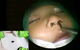 Đi tắm suối, bé trai 3 tuổi bị đỉa chui vào mũi