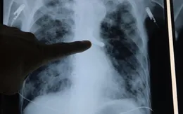 Cả hàm răng giả rơi vào... phế quản cụ ông 89 tuổi