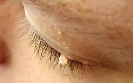 Cảnh giác với bệnh sùi mào gà ở nam giới