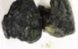 "Nghiện" trà sữa đến bỏ cơm, nam thanh niên nguy kịch vì tắc ruột