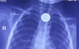 Bé trai 3 tuổi phải vào viện vì đồng xu mắc kẹt ở thực quản