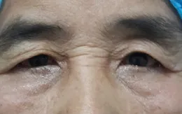 Sa trễ mi trên ở người già