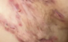 Người đàn ông chảy mủ hôi thối vì... viêm tuyến mồ hôi