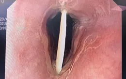 Đi ăn cỗ về, cụ bà 72 tuổi phải vào viện vì hóc xương