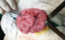 Bé trai 4 tuổi vỡ ruột vì bị ném lon bia vào bụng