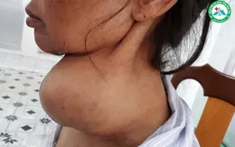 Kon Tum: Phẫu thuật thành công khối u tuyến giáp lớn nhất từ trước tới nay