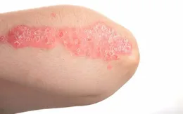 Bệnh vảy nến có lây?
