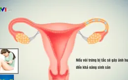 Tắc vòi trứng - Thủ phạm gây vô sinh ở phụ nữ
