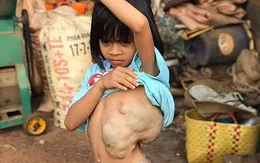Giải thoát khối bướu 4kg đeo bám trên lưng bé gái suốt 8 năm