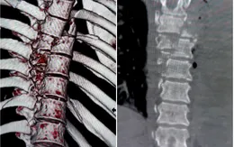 Cứu nạn nhân tai nạn giao thông bị dập nát nhiều đốt sống ngực