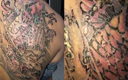 Loét da, chảy mủ sau khi đi xóa xăm