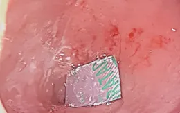 Tổn thương niêm mạc ruột vì uống thuốc còn... nguyên vỏ