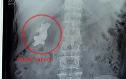 Tán nhỏ "củ gừng" trong thận người đàn ông