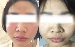 Tiêm "thuốc lạ" trị nám tại spa, người phụ nữ trẻ suýt hỏng mặt