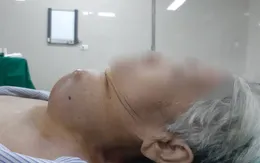 Cắt bỏ khối u tuyến giáp khổng lồ cho cụ bà 85 tuổi