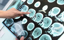 Bệnh mất trí nhớ alzheimer có sự khác biệt theo giới tính
