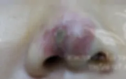 Hám rẻ, cô gái trẻ phải nhập viện sau tiêm filler
