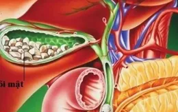 60% người tuổi trung niên bị sỏi mật