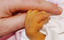 Trẻ 7 ngày tuổi phải thay máu vì sự chủ quan của cha mẹ